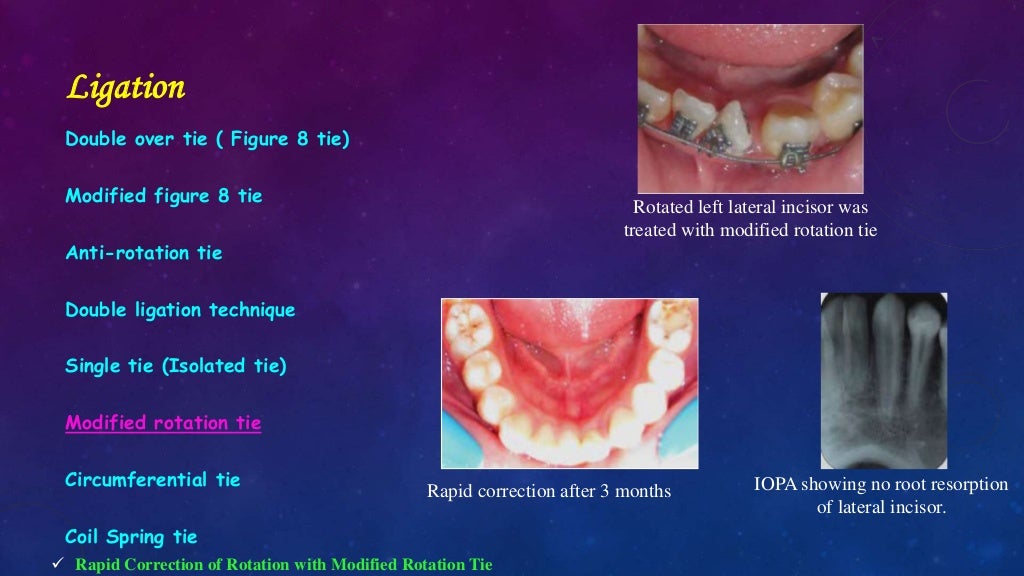 Orthodontic Correction of Rotated Teeth