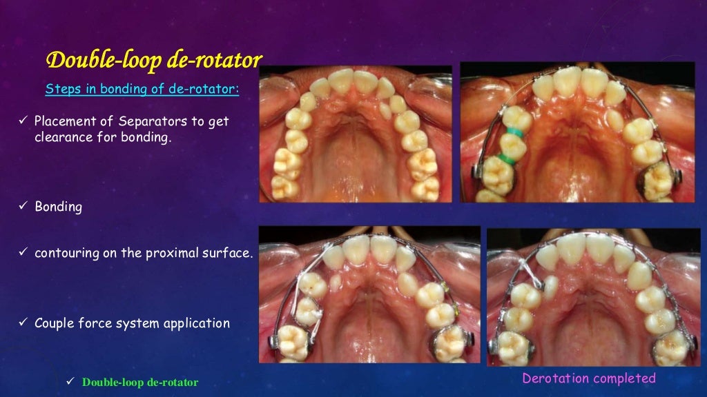 Orthodontic Correction of Rotated Teeth