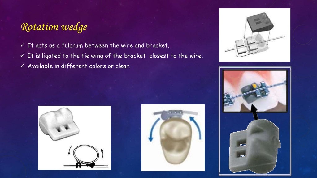 Orthodontic Correction of Rotated Teeth