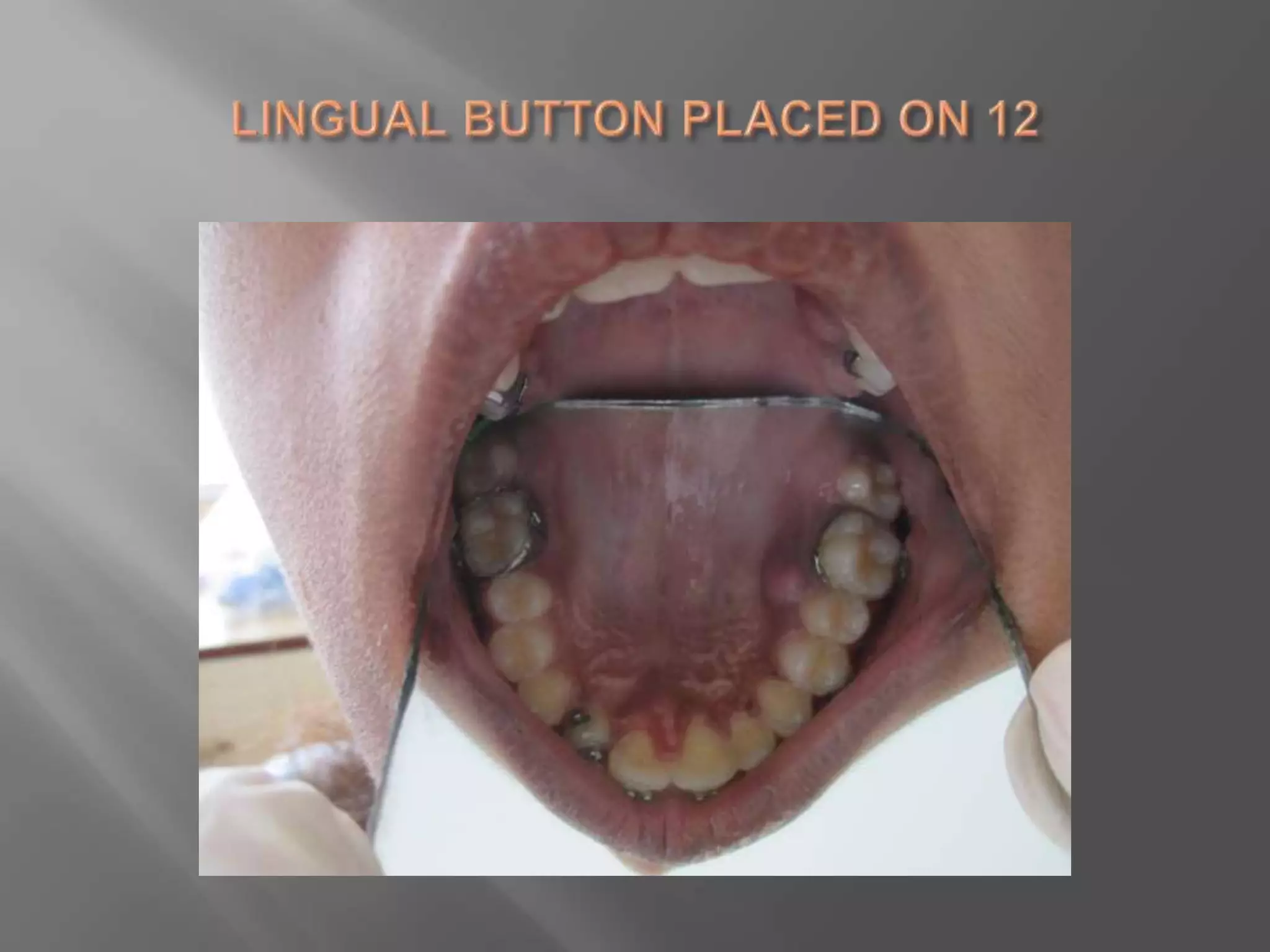 Orthodontic correction of rotated tooth
