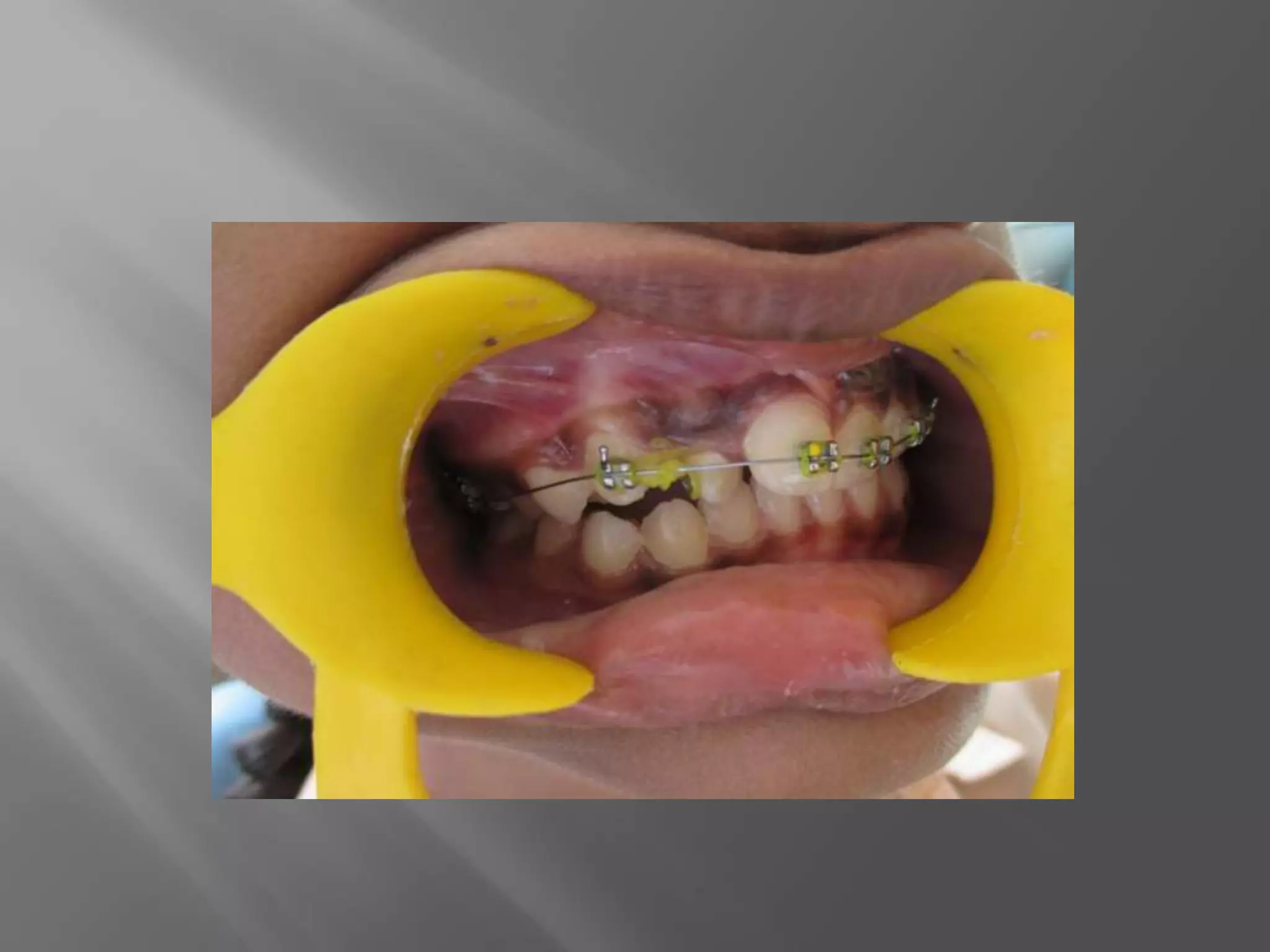 Orthodontic correction of rotated tooth