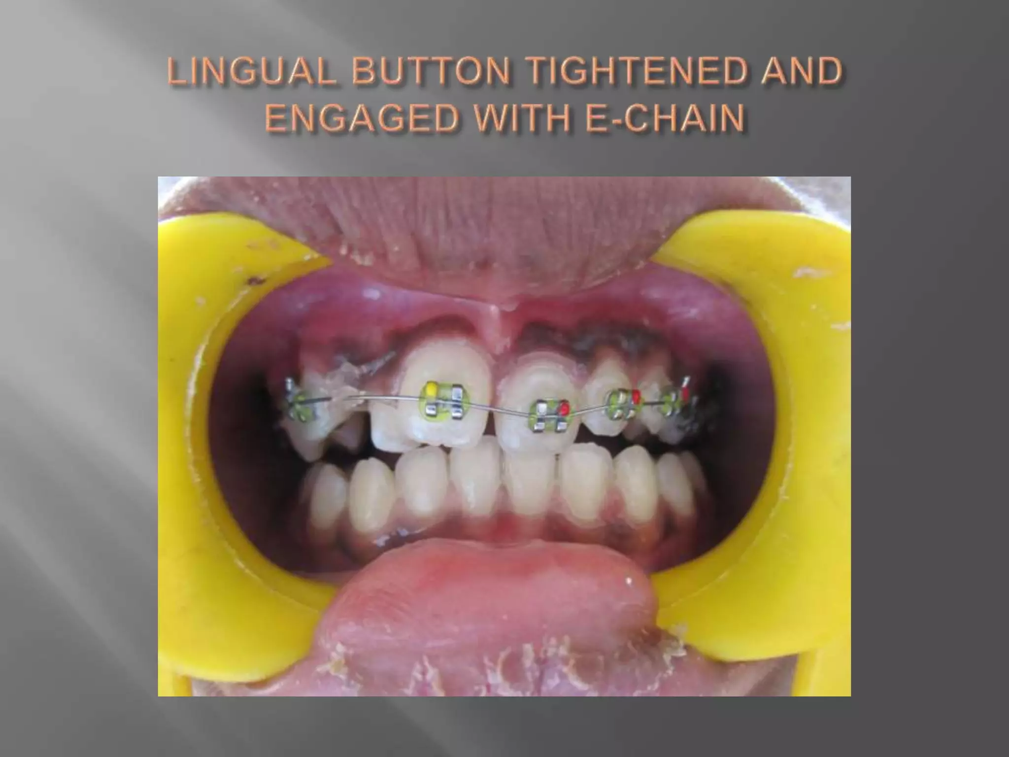 Orthodontic correction of rotated tooth