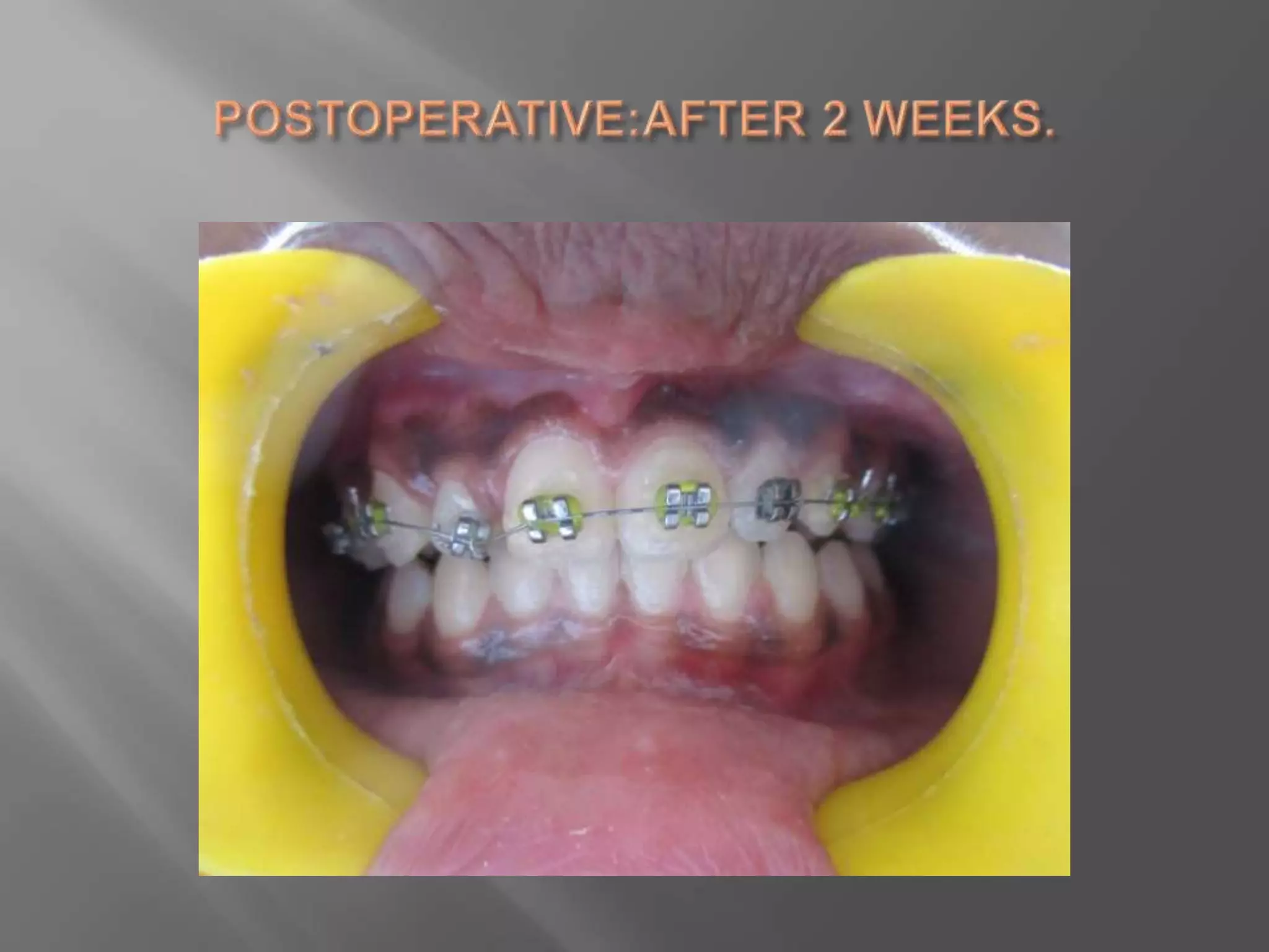 Orthodontic correction of rotated tooth