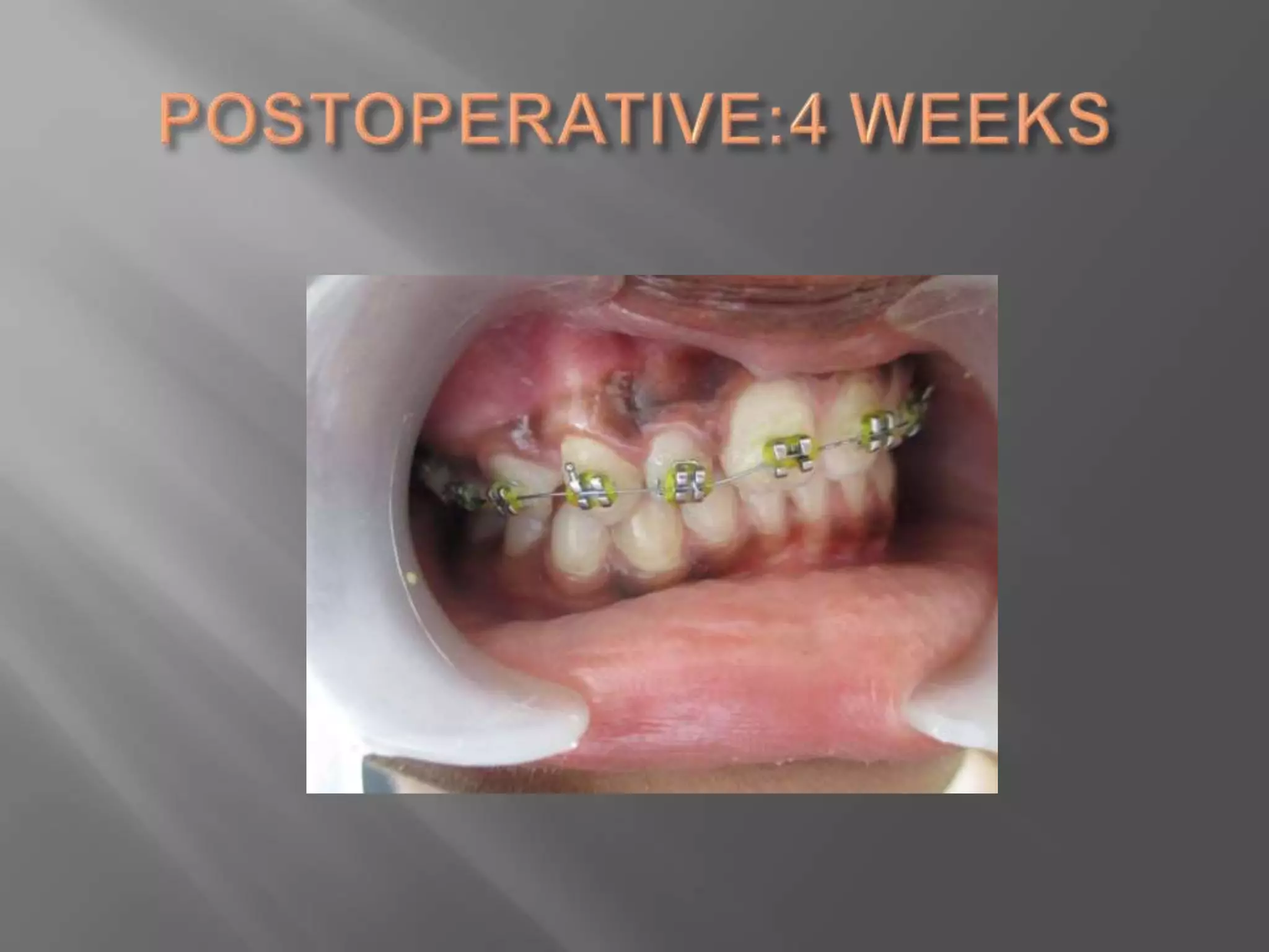 Orthodontic correction of rotated tooth