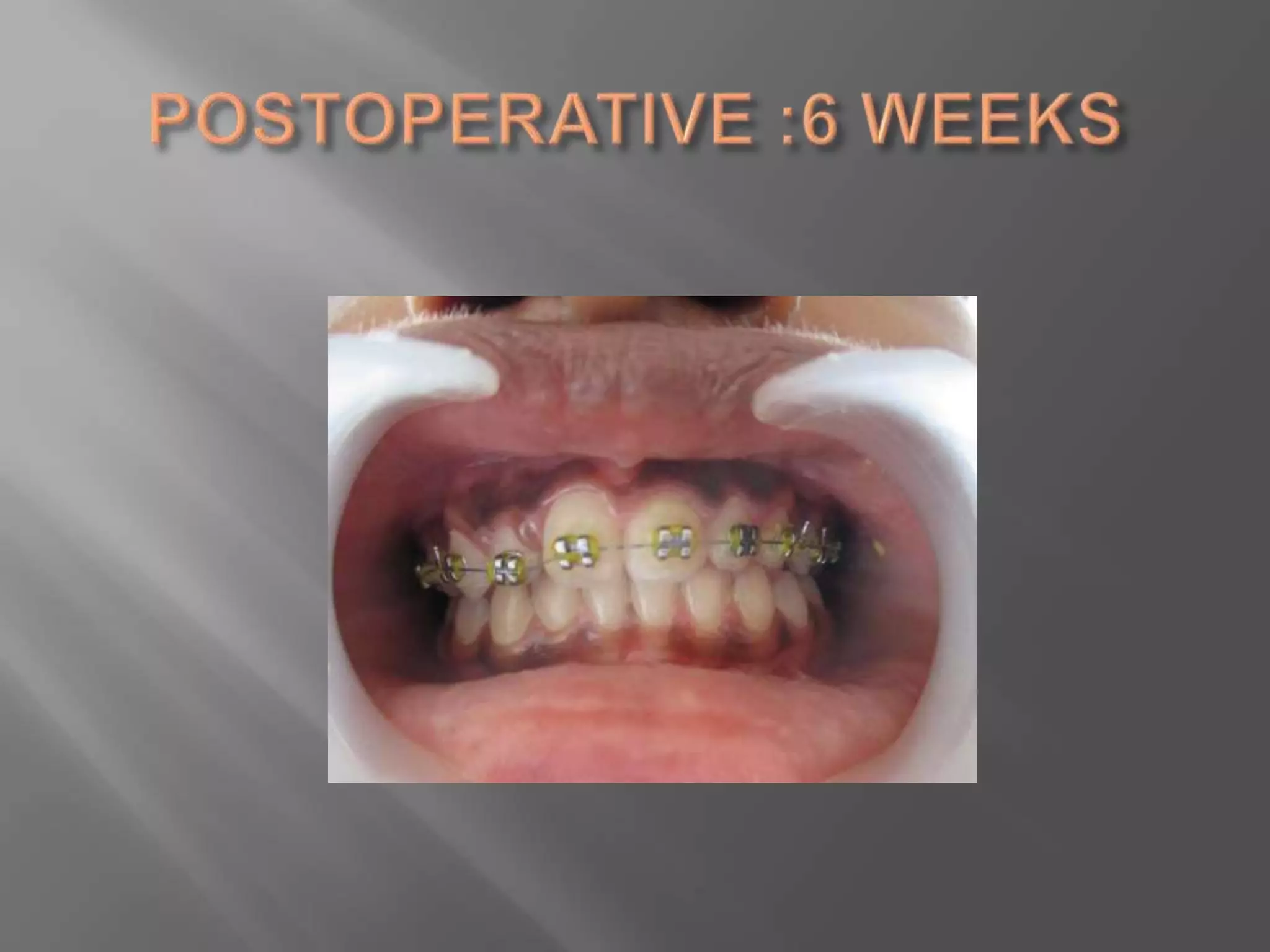 Orthodontic correction of rotated tooth