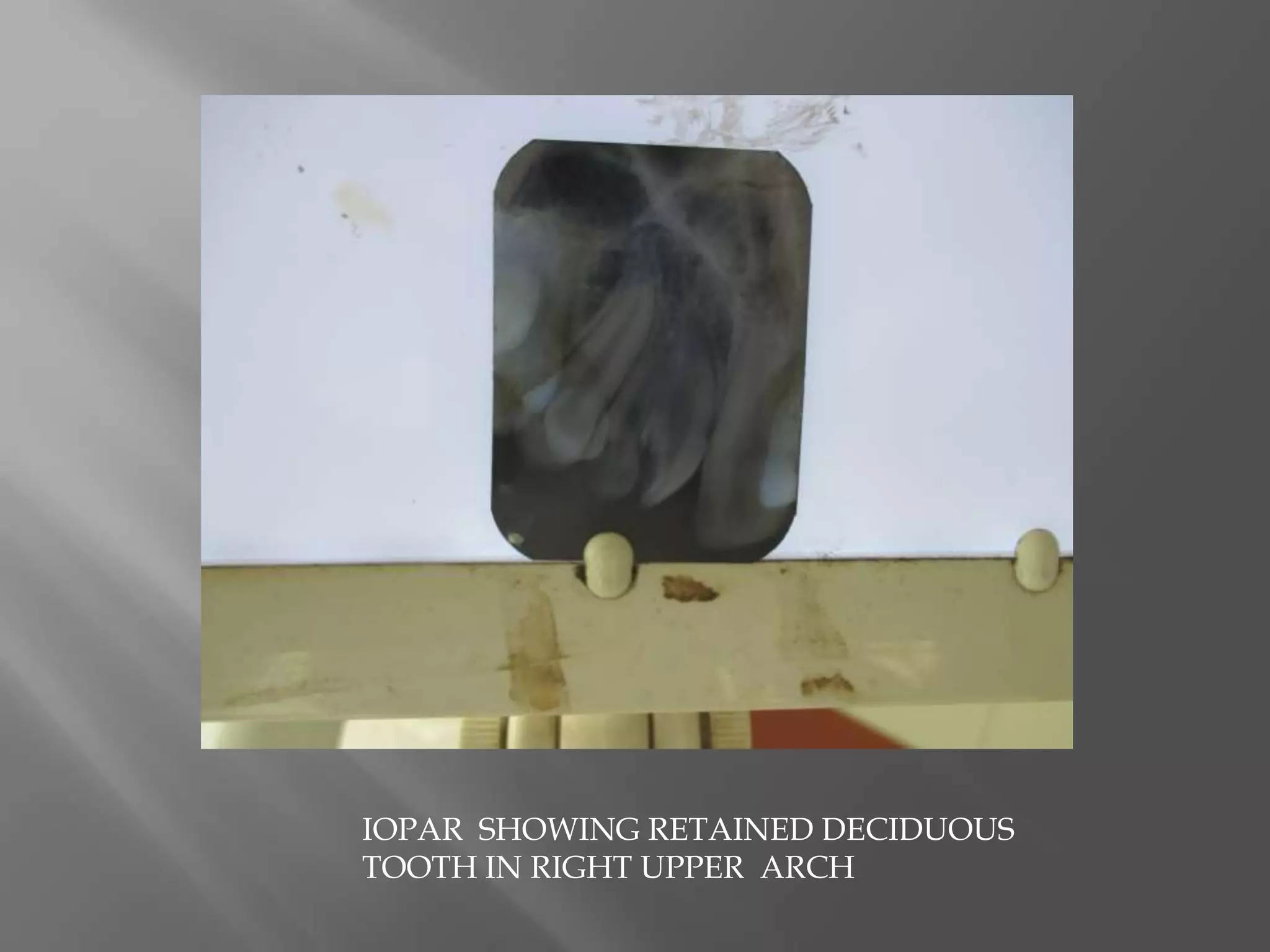 IOPAR SHOWING RETAINED DECIDUOUS
TOOTH IN RIGHT UPPER ARCH