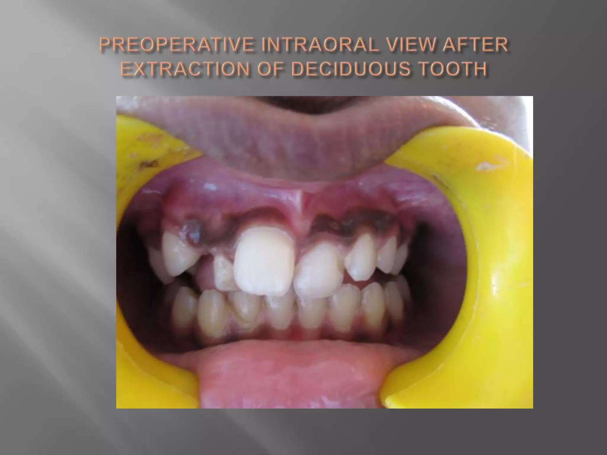 Orthodontic correction of rotated tooth