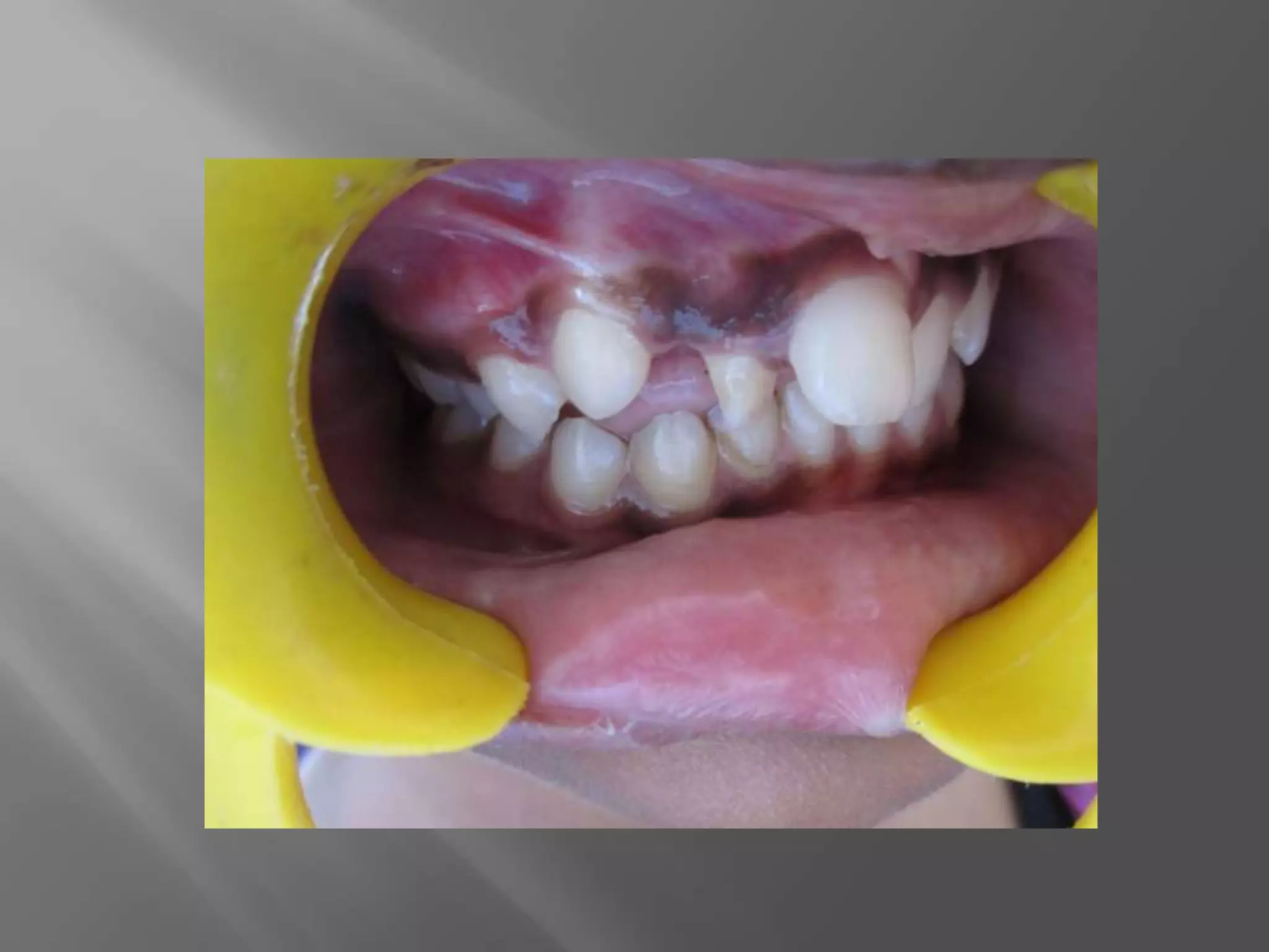 Orthodontic correction of rotated tooth