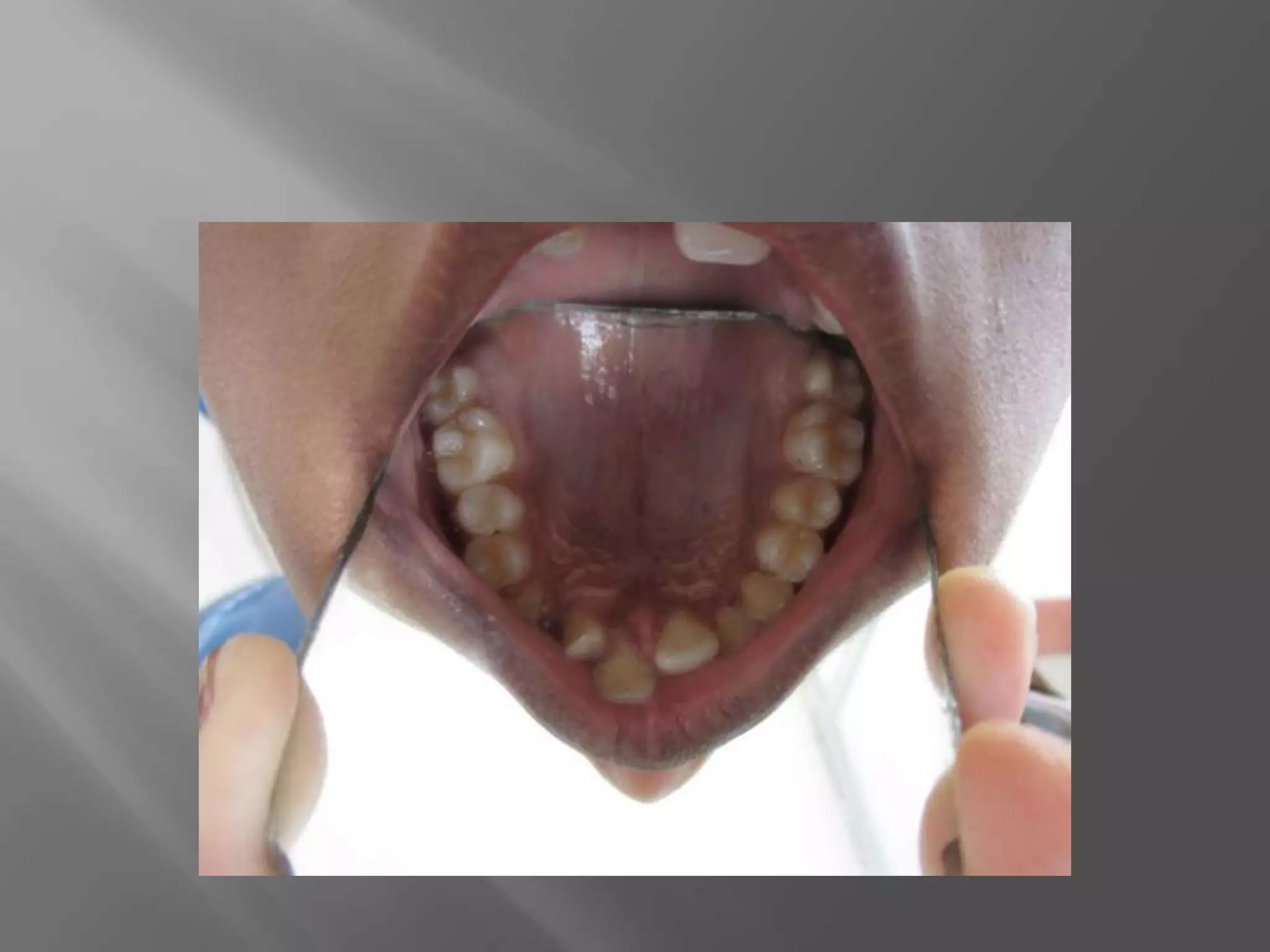 Orthodontic correction of rotated tooth