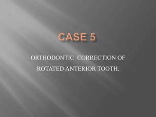 ORTHODONTIC CORRECTION OF
ROTATED ANTERIOR TOOTH.
 
