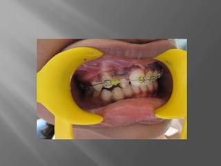 Contortion Tooth Orthodontic correction of rotated tooth | PPTX