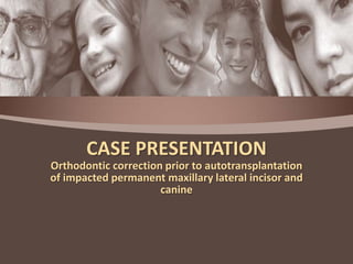 CASE PRESENTATION
Orthodontic correction prior to autotransplantation
of impacted permanent maxillary lateral incisor and
canine

 