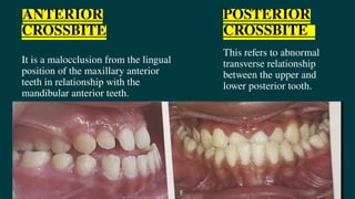 Cross bite management orthodontic CROSSBITE.pptx