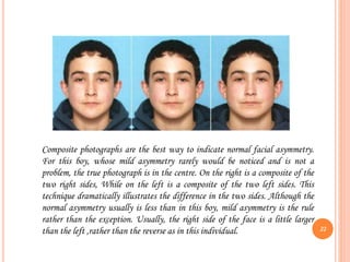 Composite photographs are the best way to indicate normal facial asymmetry.
For this boy, whose mild asymmetry rarely would be noticed and is not a
problem, the true photograph is in the centre. On the right is a composite of the
two right sides, While on the left is a composite of the two left sides. This
technique dramatically illustrates the difference in the two sides. Although the
normal asymmetry usually is less than in this boy, mild asymmetry is the rule
rather than the exception. Usually, the right side of the face is a little larger
than the left ,rather than the reverse as in this individual. 22
 