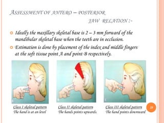 ASSESSMENT OF ANTERO – POSTERIOR
JAW RELATION :-
 Ideally the maxillary skeletal base is 2 – 3 mm forward of the
mandibular skeletal base when the teeth are in occlusion.
 Estimation is done by placement of the index and middle fingers
at the soft tissue point A and point B respectively.
Class I skeletal pattern
The hand is at an level
Class II skeletal pattern
The hands points upwards.
Class III skeletal pattern
The hand points downward
28
 