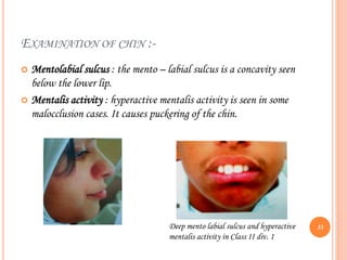 EXAMINATION OF CHIN :-
 Mentolabial sulcus : the mento – labial sulcus is a concavity seen
below the lower lip.
 Mentalis activity : hyperactive mentalis activity is seen in some
malocclusion cases. It causes puckering of the chin.
Deep mento labial sulcus and hyperactive
mentalis activity in Class II div. 1
33
 