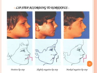 oLIP STEP ACCORDING TO KORKHAUS :-
Positive lip step Slightly negative lip step Marked negative lip step
34
 