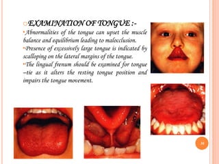oEXAMINATION OF TONGUE :-
•Abnormalities of the tongue can upset the muscle
balance and equilibrium leading to malocclusion.
•Presence of excessively large tongue is indicated by
scalloping on the lateral margins of the tongue.
•The lingual frenum should be examined for tongue
–tie as it alters the resting tongue position and
impairs the tongue movement.
36
 