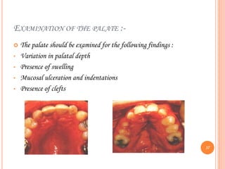 EXAMINATION OF THE PALATE :-
 The palate should be examined for the following findings :
• Variation in palatal depth
• Presence of swelling
• Mucosal ulceration and indentations
• Presence of clefts
37
 
