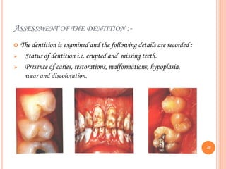 ASSESSMENT OF THE DENTITION :-
 The dentition is examined and the following details are recorded :
 Status of dentition i.e. erupted and missing teeth.
 Presence of caries, restorations, malformations, hypoplasia,
wear and discoloration.
40
 