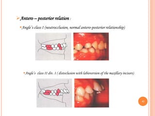 Antero – posterior relation :
Angle’s class I (neutrocclusion, normal antero-posterior relationship)
Angle’s class II div. 1 ( distoclusion with labioversion of the maxillary incisors)
41
 