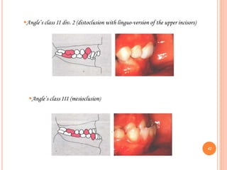 Angle’s class II div. 2 (distoclusion with linguo-version of the upper incisors)
Angle’s class III (mesioclusion)
42
 