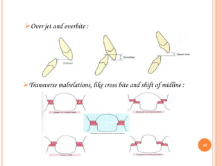 Over jet and overbite :
Transverse malrelations, like cross bite and shift of midline :
43
 