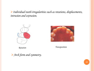 Individual tooth irregularities such as rotations, displacements,
intrusion and extrusion.
Rotation Transposition
Arch form and symmetry.
44
 
