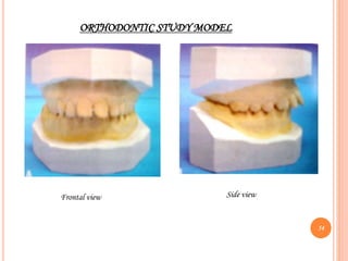 ORTHODONTIC STUDY MODEL
Frontal view Side view
54
 