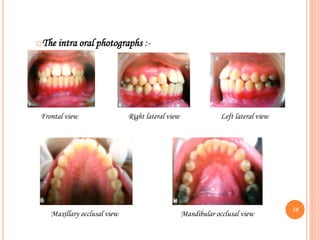 oThe intra oral photographs :-
Frontal view Right lateral view Left lateral view
Maxillary occlusal view Mandibular occlusal view
58
 