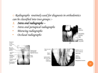 o Radiographs routinely used for diagnosis in orthodontics
can be classified into two groups :-
1. Intra oral radiographs –
• Intra oral periapical radiographs
• Bitewing radiographs
• Occlusal radiographs
61
 