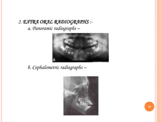 2. EXTRA ORAL RADIOGRAPHS :-
a. Panoramic radiographs –
b. Cephalometric radiographs –
62
 