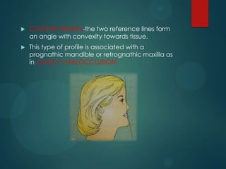  COCAVE PROFILE-the two reference lines form
an angle with convexity towards tissue.
 This type of profile is associated with a
prognathic mandible or retrognathic maxilla as
in CLASS 11 MALOCCLUSION.
 