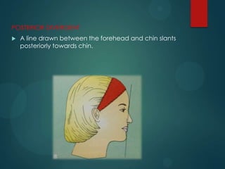 POSTERIOR DIVERGENT
 A line drawn between the forehead and chin slants
posteriorly towards chin.
 