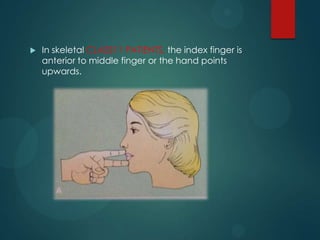  In skeletal CLASS11 PATIENTS, the index finger is
anterior to middle finger or the hand points
upwards.
 