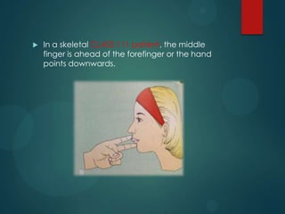  In a skeletal CLASS 111 patient, the middle
finger is ahead of the forefinger or the hand
points downwards.
 