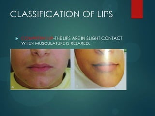CLASSIFICATION OF LIPS
 COMPETENT LIP-THE LIPS ARE IN SLIGHT CONTACT
WHEN MUSCULATURE IS RELAXED.
 