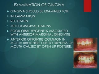 EXAMINATION OF GINGIVA
 GINGIVA SHOULD BE EXAMINED FOR
1. INFLAMMATION
2. RECESSION
3. MUCOGINGIVAL LESIONS
 POOR ORAL HYGEINE IS ASSOSIATED
WITH ANTERIOR MARGINAL GINGIVITIS.
 ANTERIOR GINGIVITIS COMMON IN
MOUTH BREATHERS DUE TO DRYNESS OF
MOUTH CAUSED BY OPEN LIP POSTURE.
 