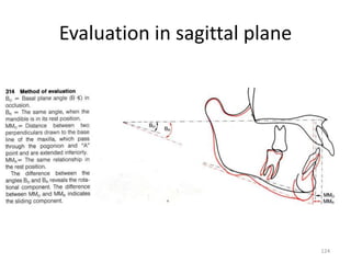 Evaluation in sagittal plane
124
 