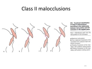 Class II malocclusions
125
 