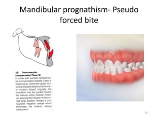 Mandibular prognathism- Pseudo
forced bite
127
 