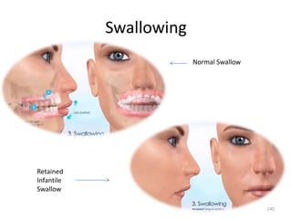 Swallowing
Normal Swallow
Retained
Infantile
Swallow
140
 