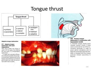 Tongue thrust
142
 