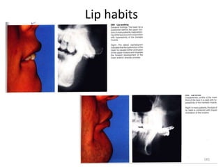 Lip habits
145
 