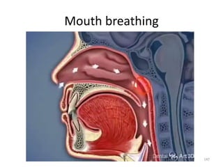 Mouth breathing
147
 