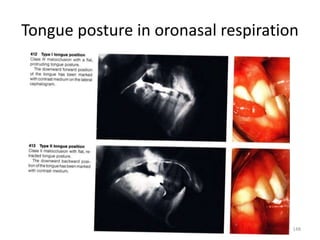 Tongue posture in oronasal respiration
148
 