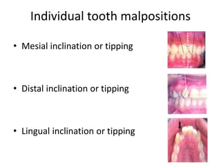 Individual tooth malpositions
• Mesial inclination or tipping
• Distal inclination or tipping
• Lingual inclination or tipping
160
 
