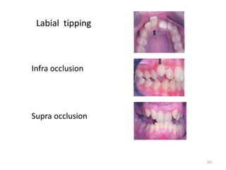 Labial tipping
Infra occlusion
Supra occlusion
161
 