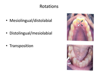 Rotations
• Mesiolingual/distolabial
• Distolingual/mesiolabial
• Transposition
162
 