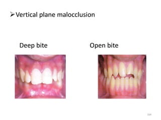 Vertical plane malocclusion
Deep bite Open bite
164
 